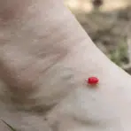 how to get rid of chiggers in yard